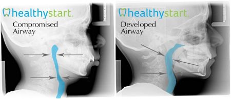 Compromised-vs.-Developed-Airway