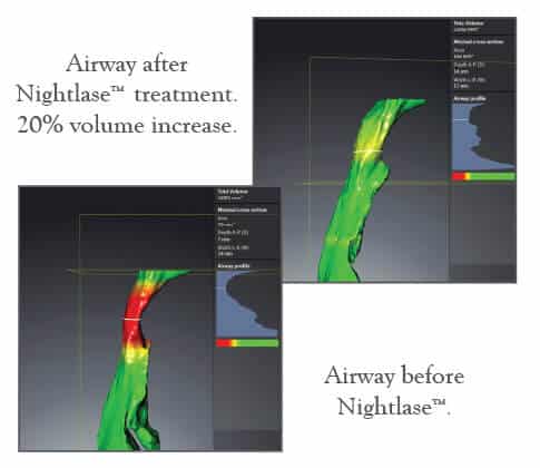 3D airway scans comparing before and after Nightlase treatment showing 20% volume increase