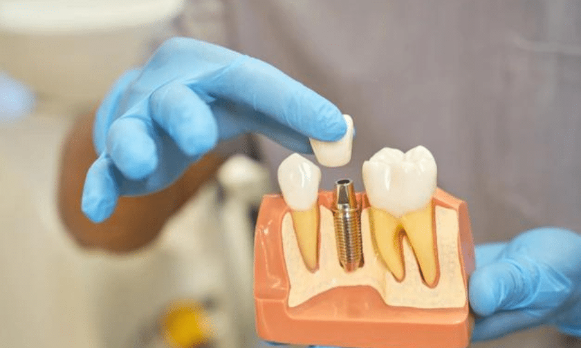 dental implants Sioux Falls