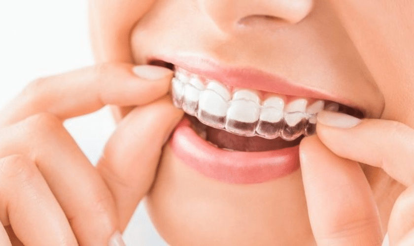 Invisalign image on Designer Dentistry website