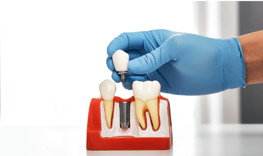 DENTAL IMPLANTS IN SIOUX FALL, Designer Dentistry & Smiles