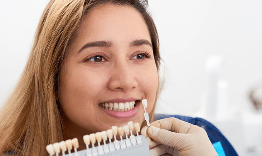 Veneers