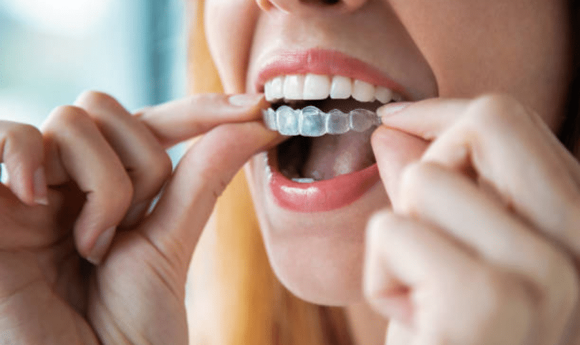 Invisalign