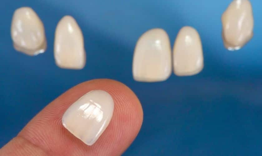 Dental Veneers Sioux Falls