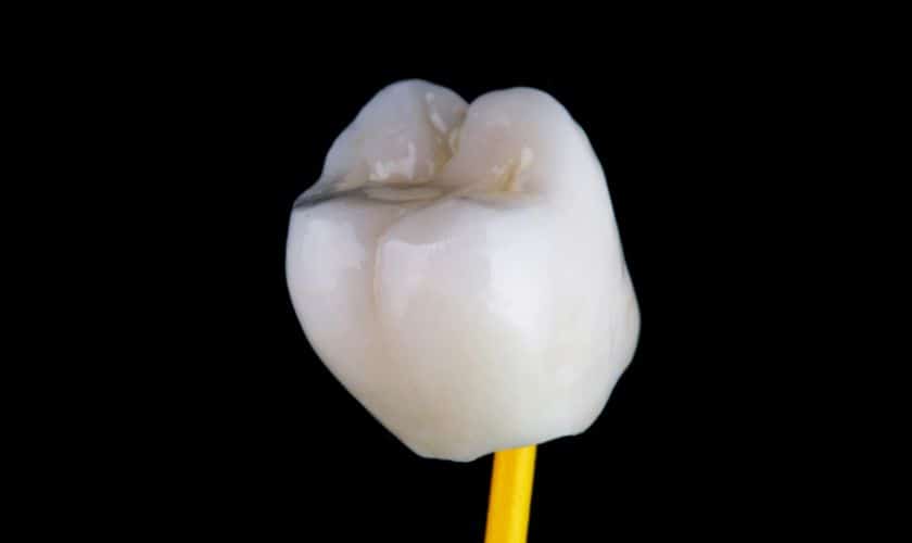 Dental Crowns Sioux Falls