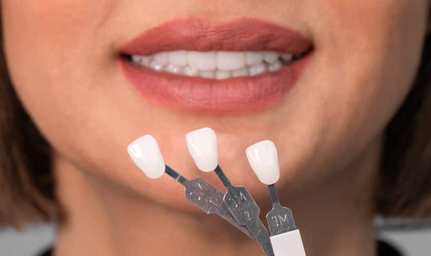 Role of Dental Veneers