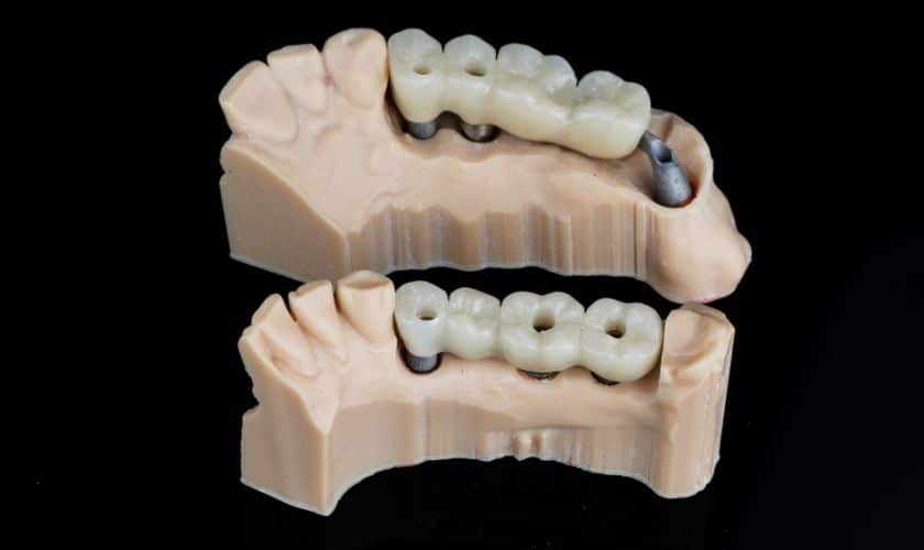 Dental Bridges for Multiple Missing Teeth