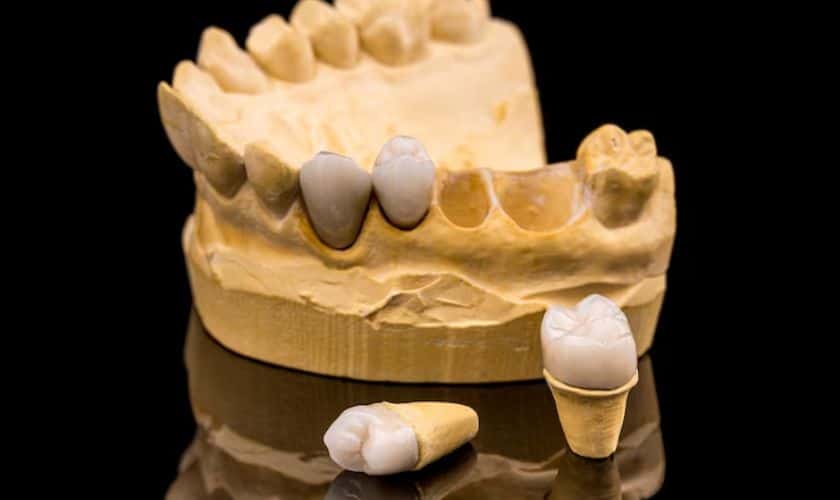 Dental Crowns Sioux Falls