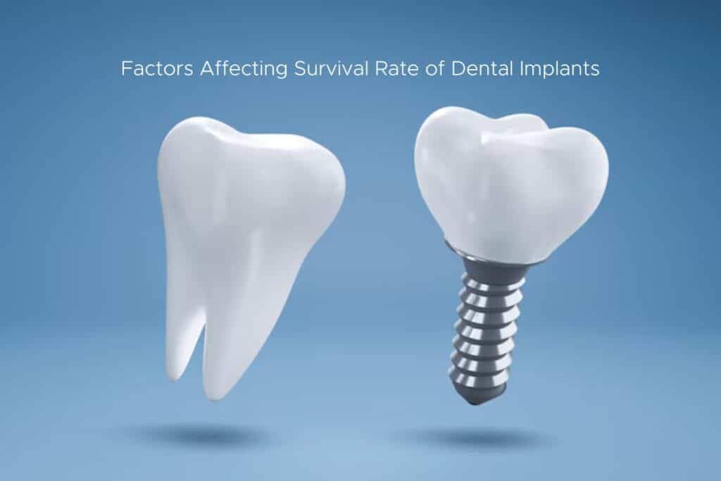 Factors Affecting Survival Rate of Dental Implants
