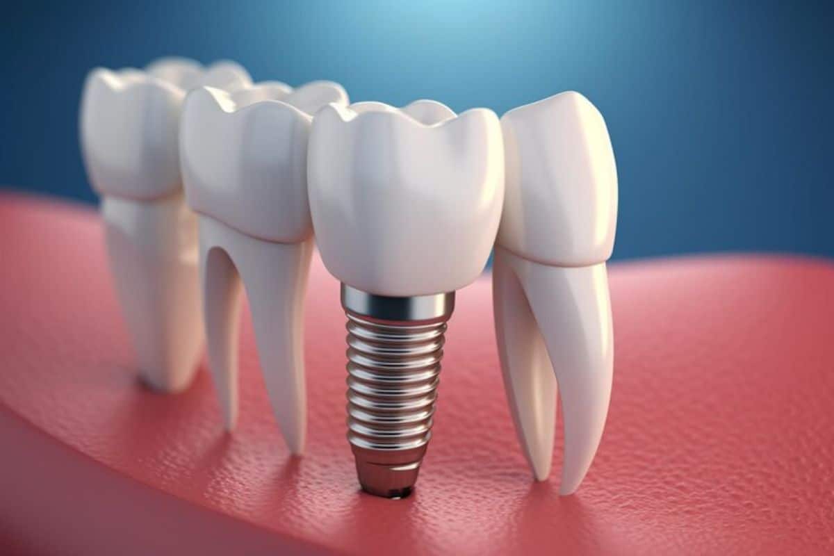 Alternative to Tooth Implant