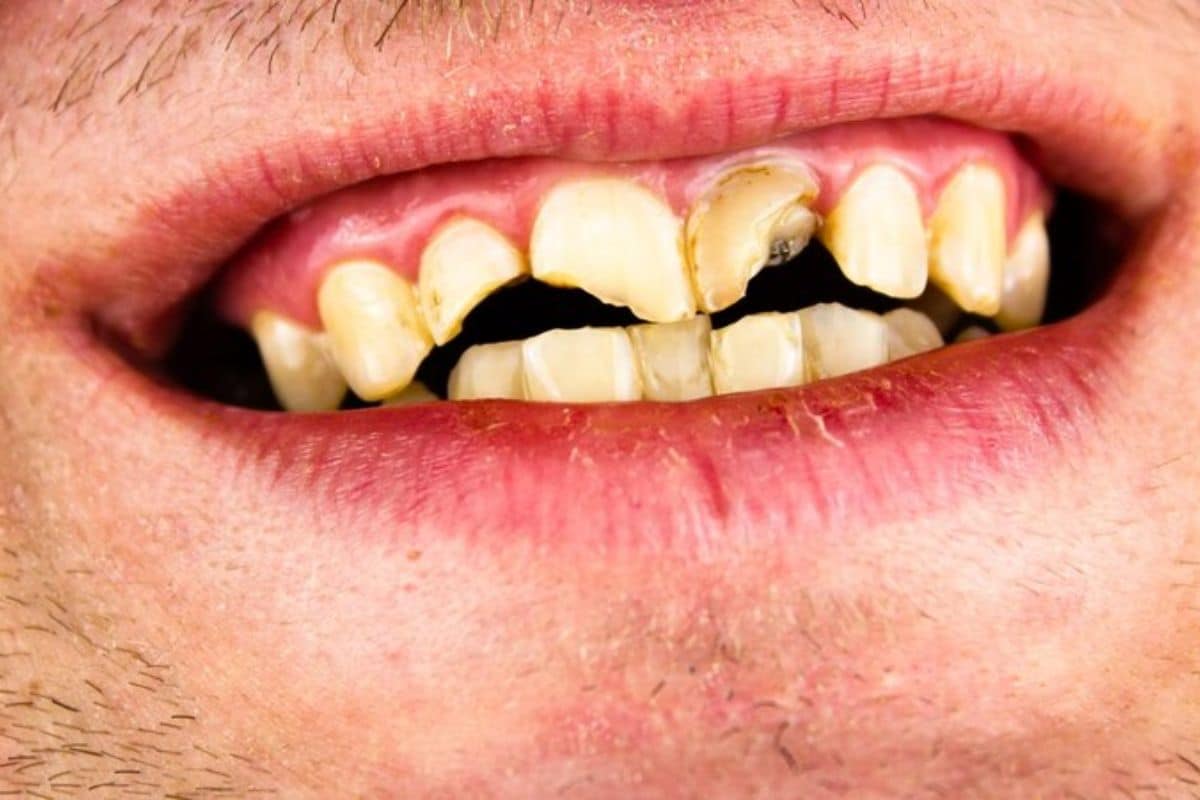 Best Tooth Decay Treatment