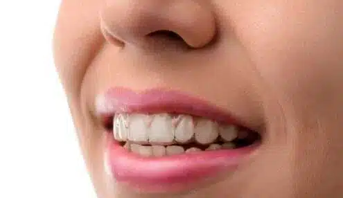 img Invisalign cosmetic lp
