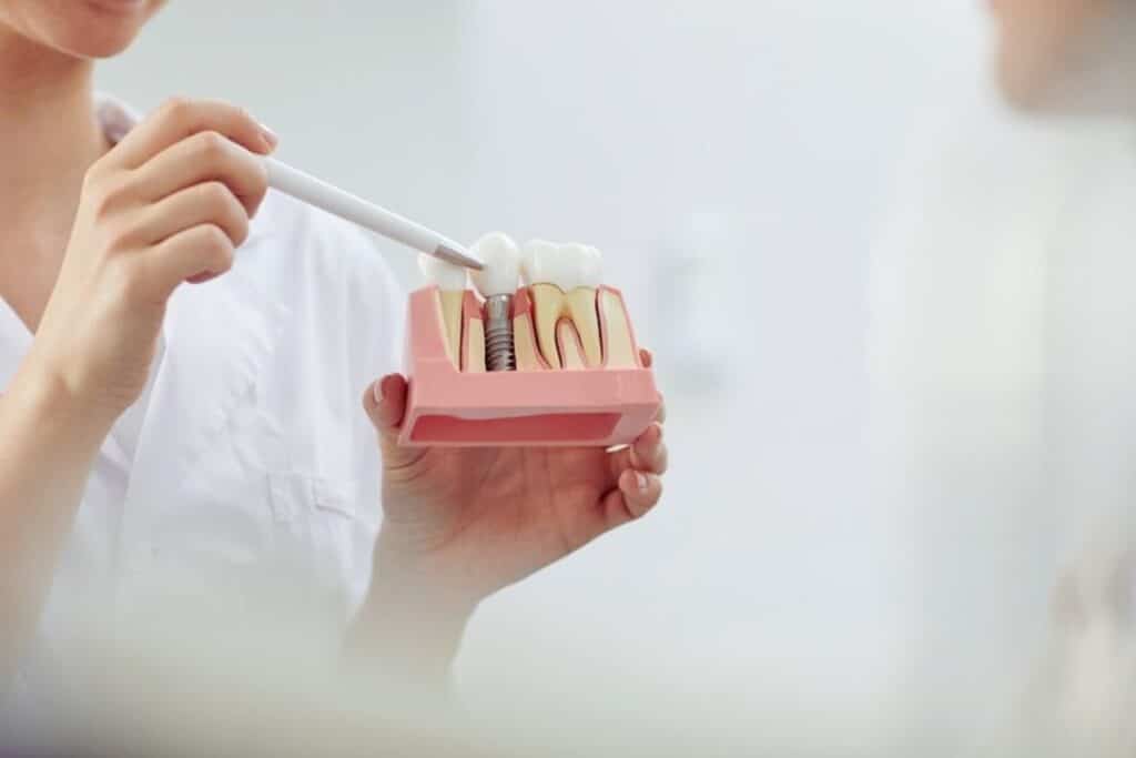 Do Implants Prevent Jawbone Loss - explained by dentist in sioux falls