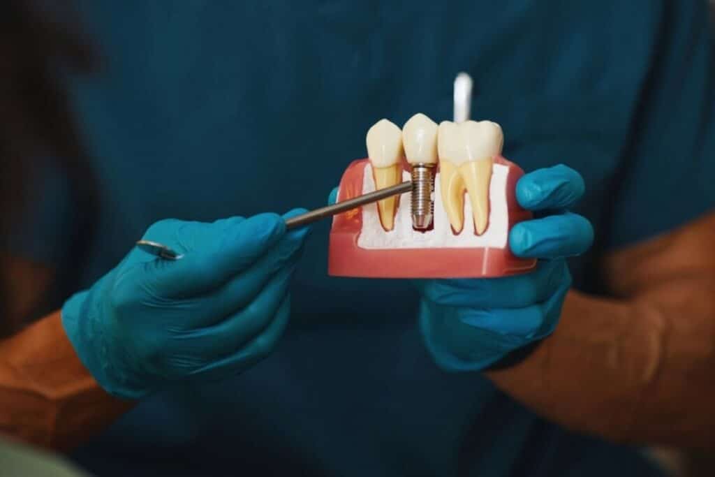 Control Bleeding After Dental Implant Surgery