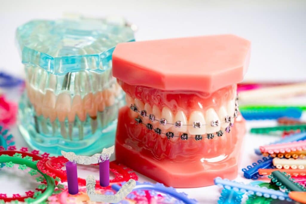Is Invisalign Faster Than Braces