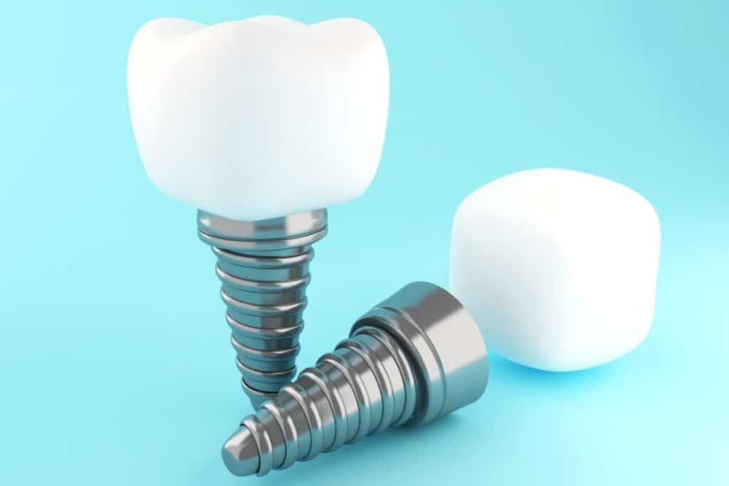 Dental Implant Screw Sioux Falls