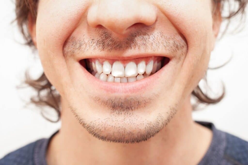 White Spots on Teeth Sioux Falls