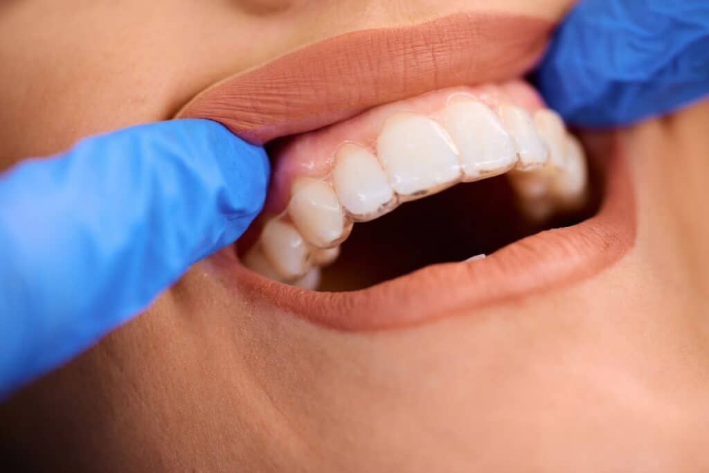 Can Invisalign Really Fix an Overbite