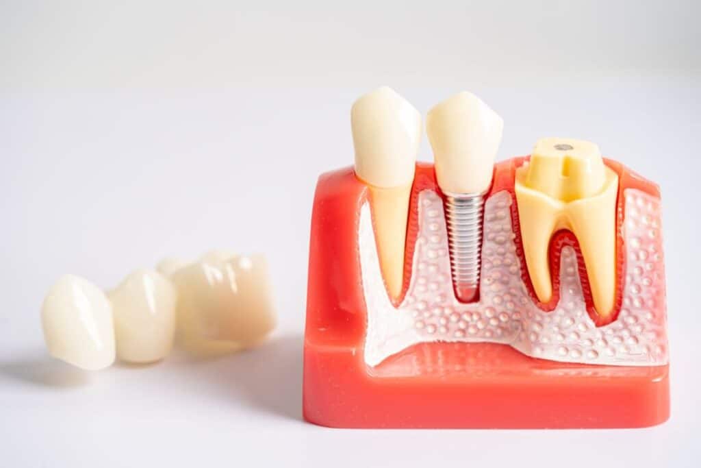 Can Dental Implants Get Infected
