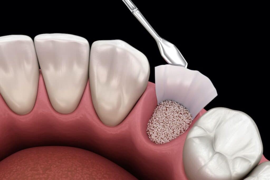Are Bone Grafts Necessary If You Want To Get Dentures