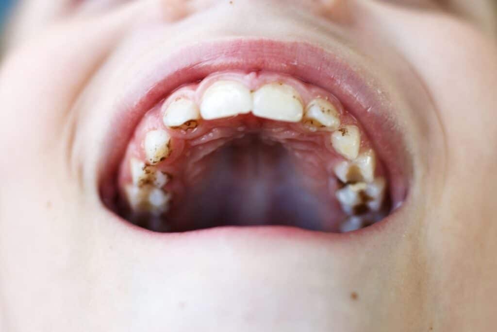 Black Lines On Teeth