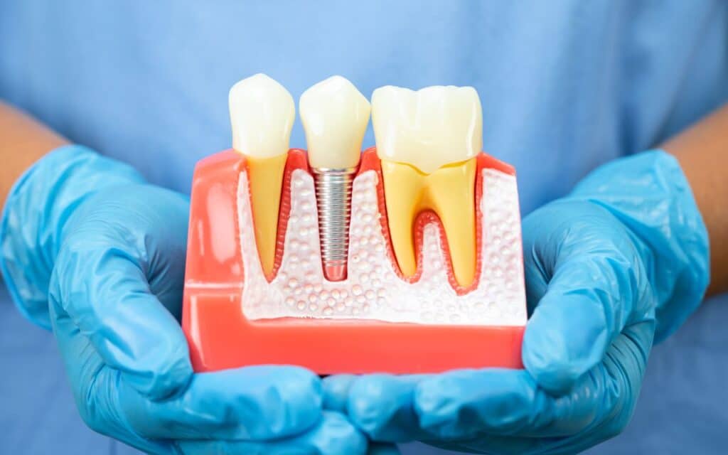 Do Dental Implants Hurt