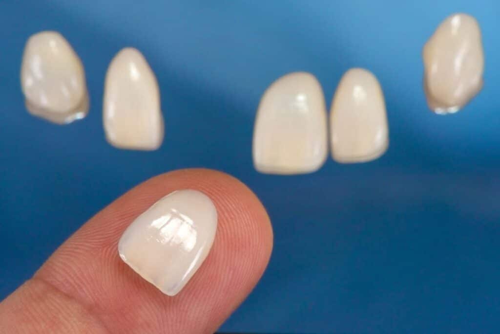 Are Veneers Worth It