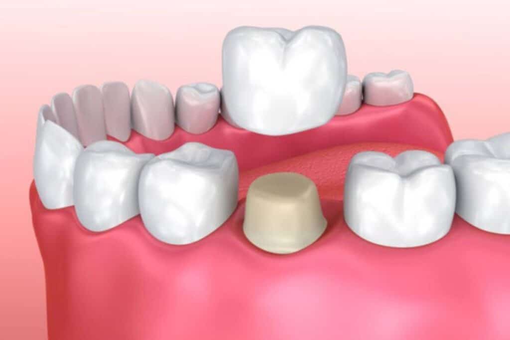 Can You Get A Crown On Your Front Tooth