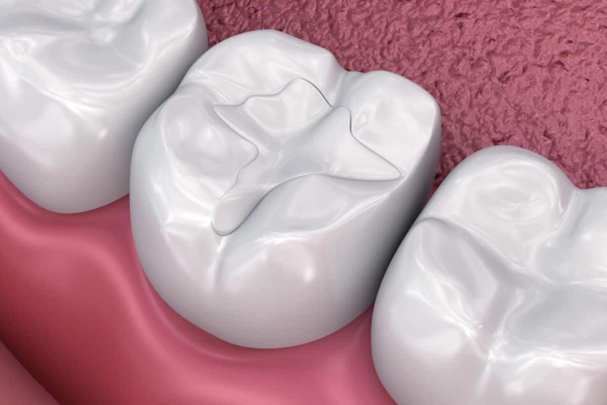 Does Getting A Tooth Filling Hurt Sioux Falls
