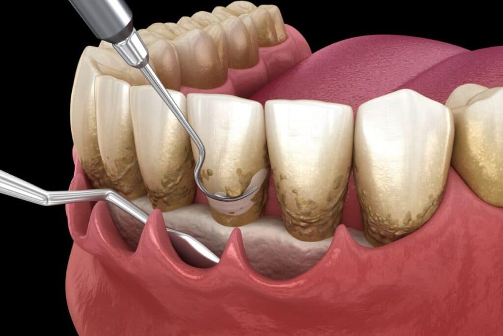 Get Plaque Off Teeth