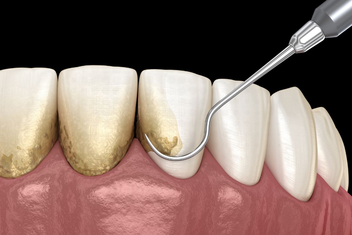 How to Remove Tartar From Teeth