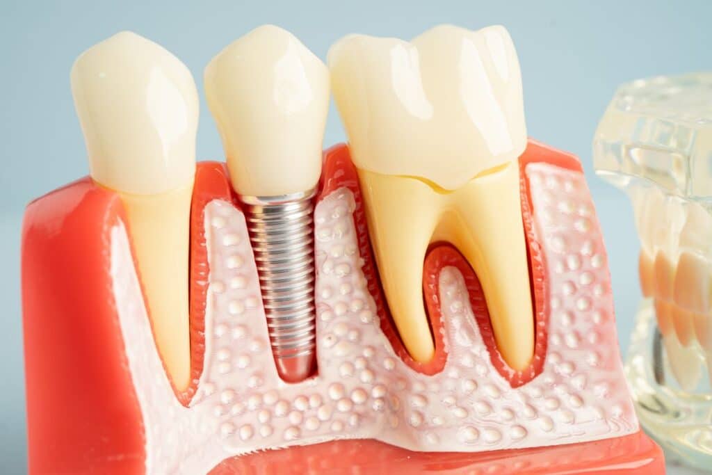 Foods to Eat and Avoid After Getting Dental Implants