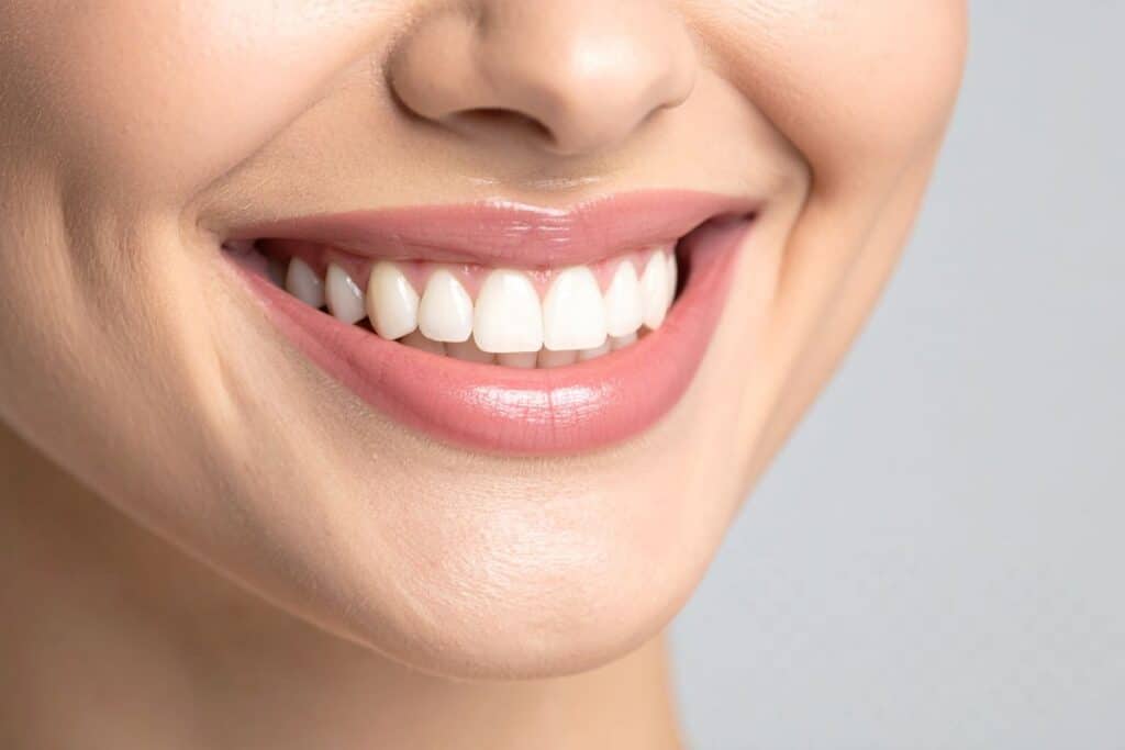 Veneers or Whitening