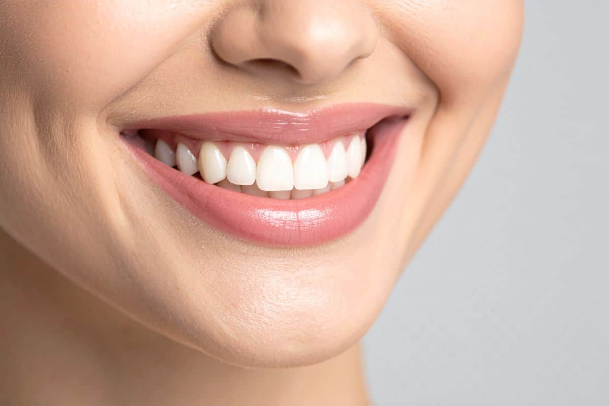 Veneers or Whitening