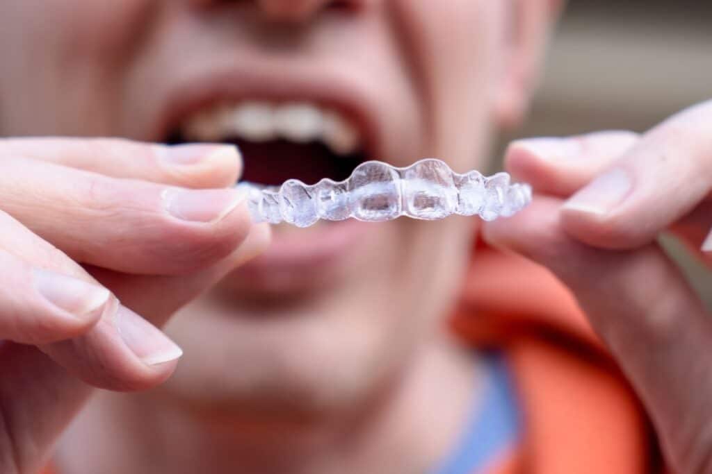 sioux-falls-invisalign-treatment