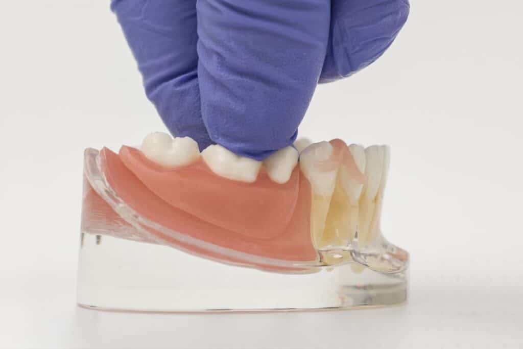 modern-denture-fittings-comfort-fit