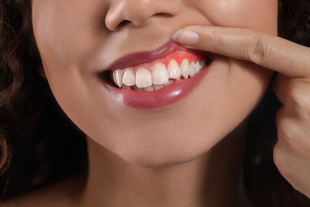 Signs of Gum Disease