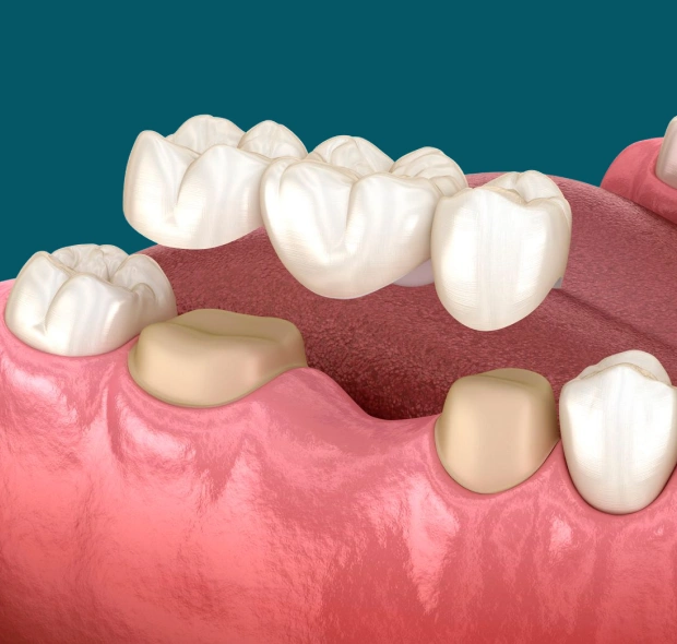 Dental bridge replacing missing teeth