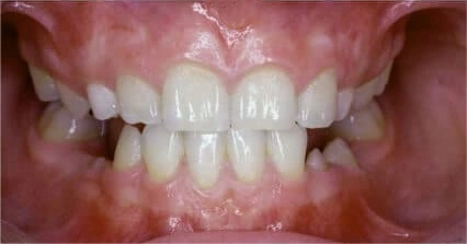 Close-up of teeth showing mild crowding and uneven alignment