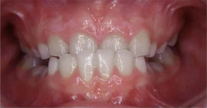 Close-up of teeth showing crowded and misaligned front teeth
