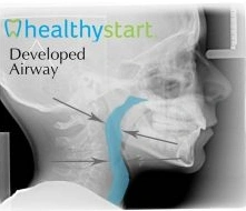 X-ray showing compromised airway with reduced airway space