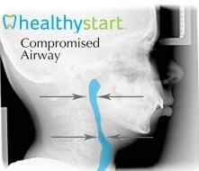 X-ray showing developed airway with open airway space