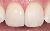 Teeth after cosmetic dental bonding treatment