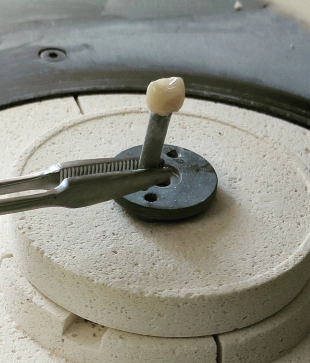 Dental crown shown on a prepared tooth