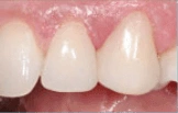 Front teeth after dental bonding treatment