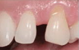 Front teeth before dental bonding treatment