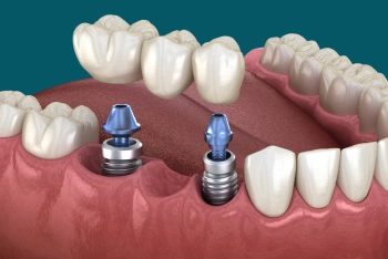 Dental implants supporting a fixed bridge for missing teeth