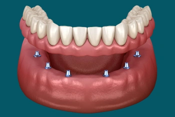 Implant-supported dental bridge replacing missing teeth