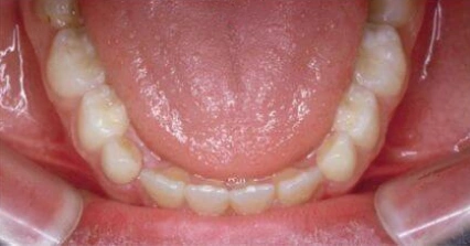 Lower teeth showing mild crowding and uneven alignment