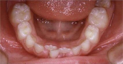 Lower teeth before crowding correction treatment